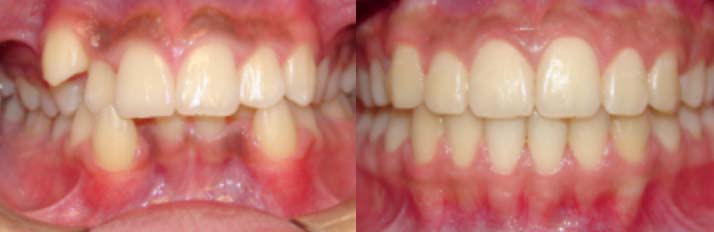 Braces Before and After Pictures Greenbelt, MD